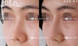 微整形隆鼻最新爆料视频